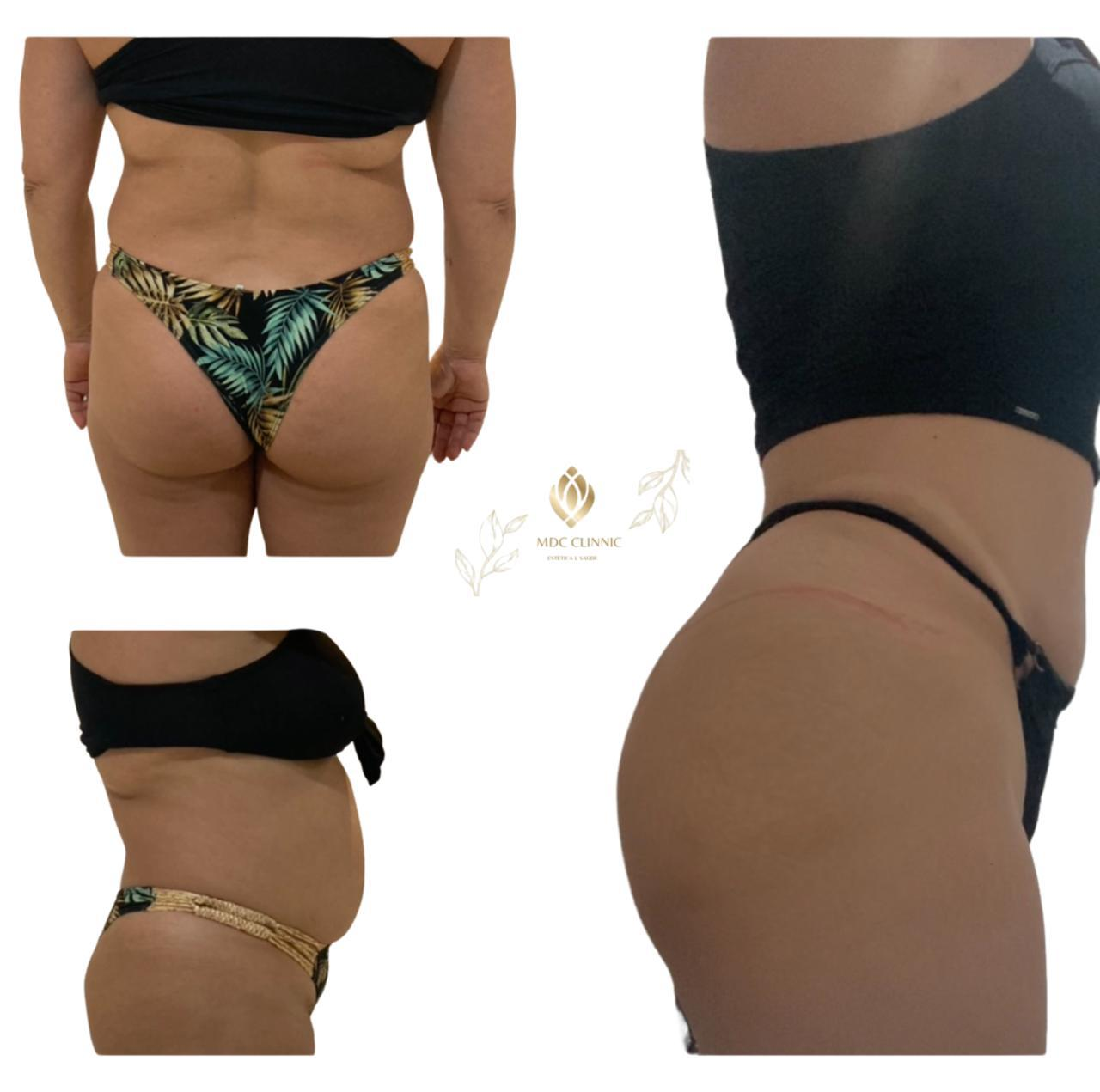 Modelagem abdominal — antes e depois