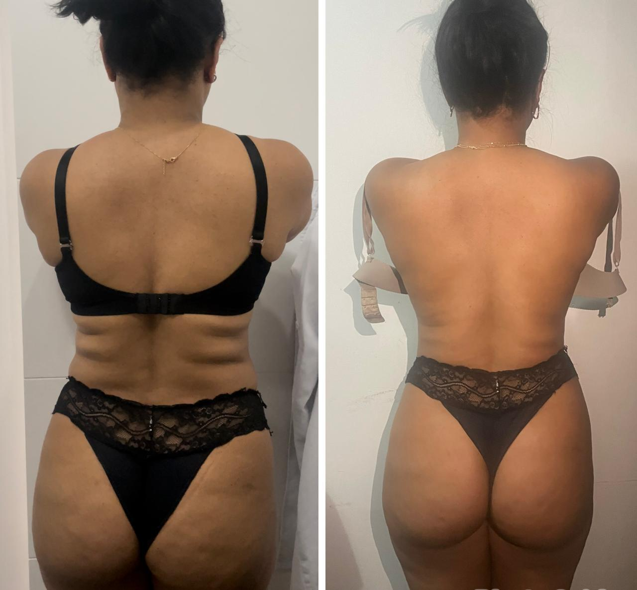 Remodelagem de costas — antes e depois