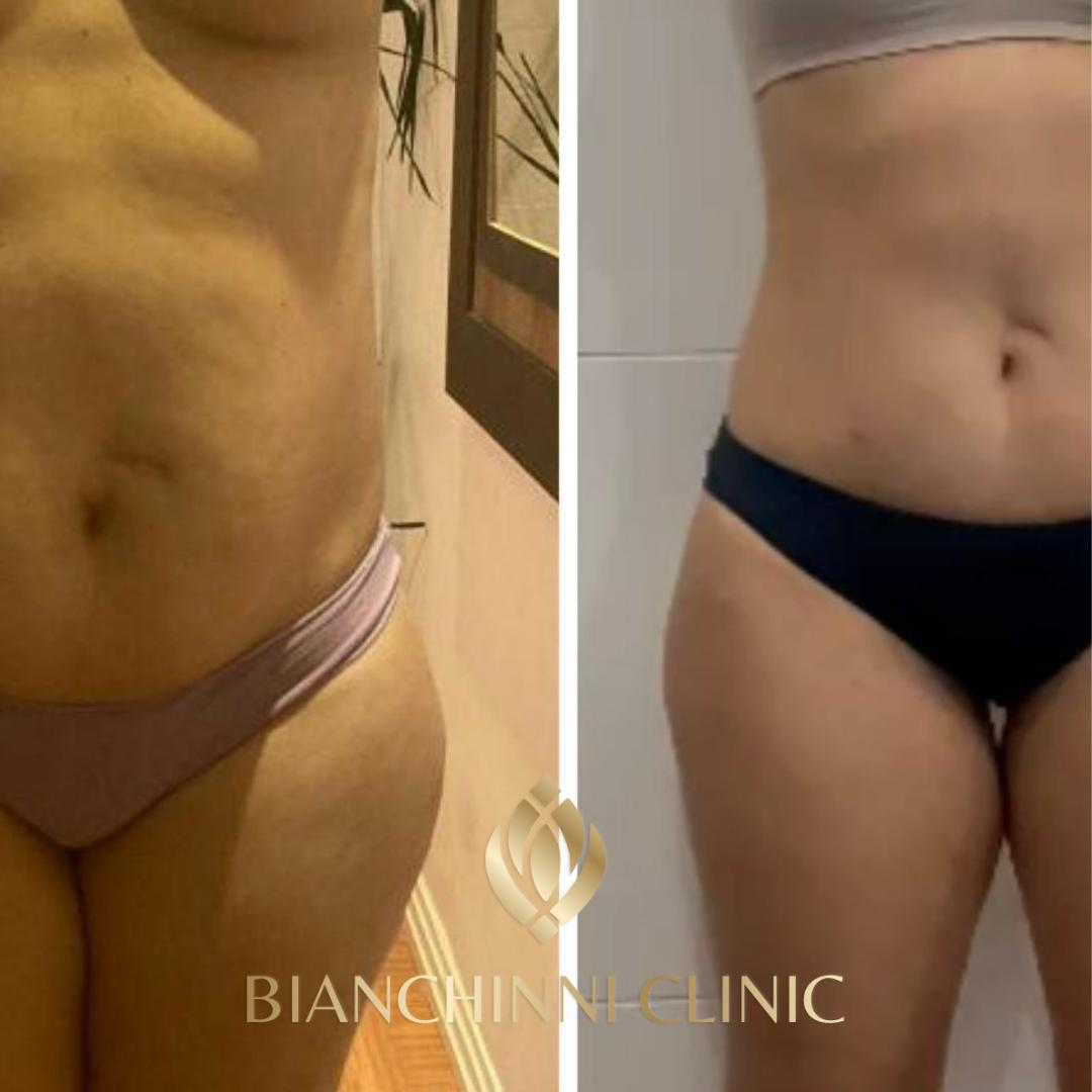 Definição de silhueta — antes e depois