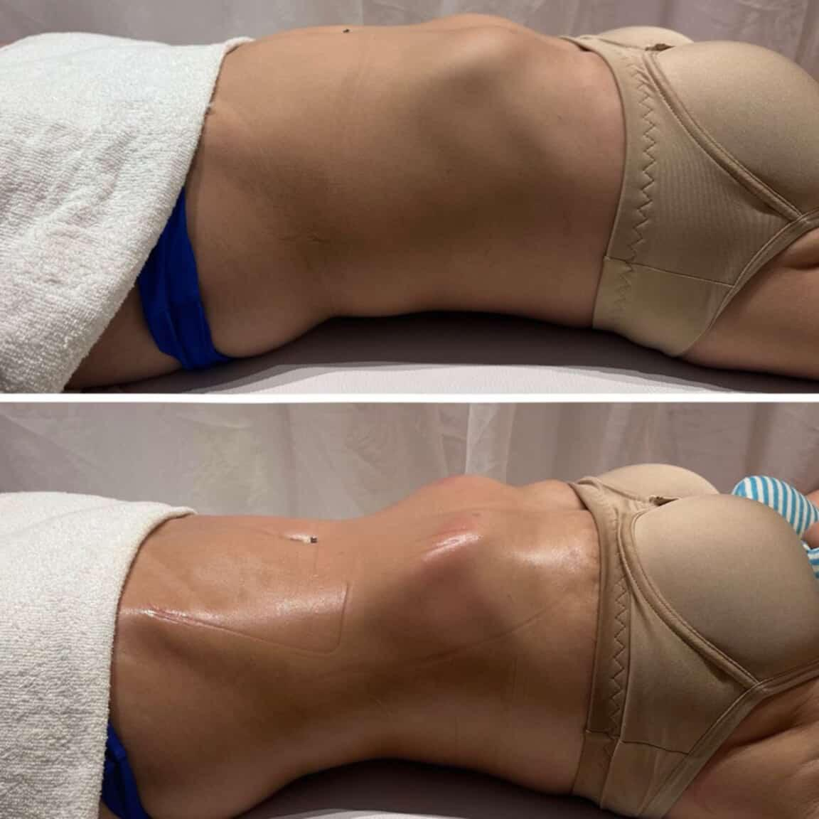 Drenagem & tônus — antes e depois