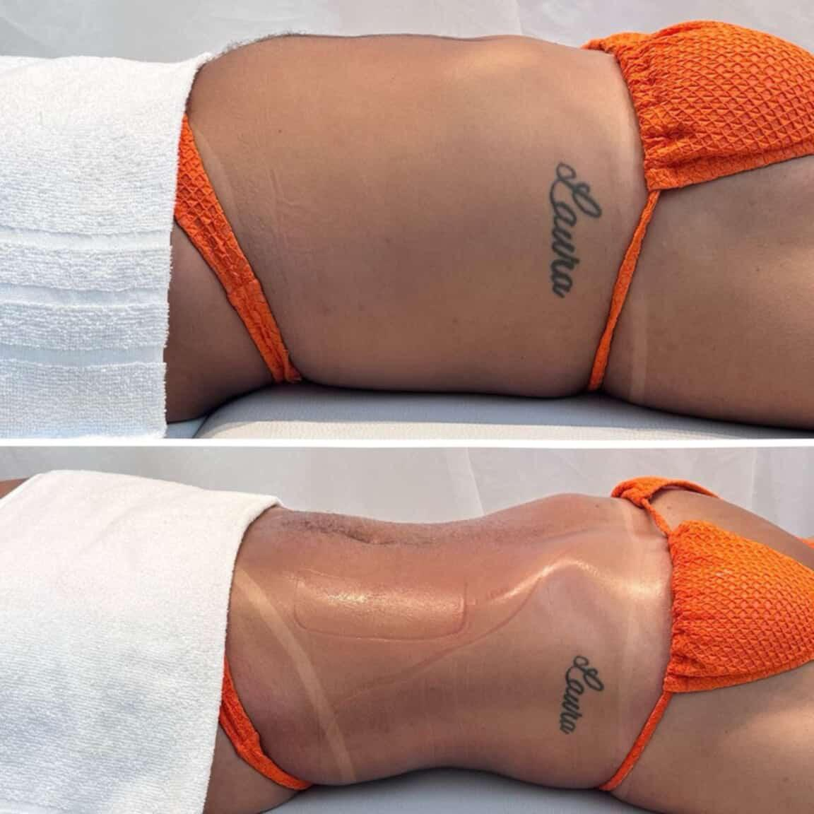 Contorno corporal — antes e depois